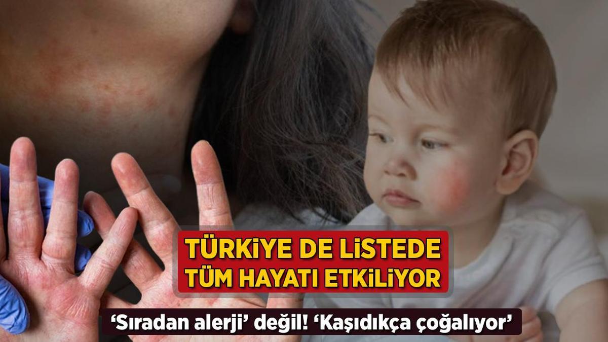 turkiye de listede tum hayati kotu etkiliyor siradan alerji degil kasidikca cogalir WHdluWQi.jpg